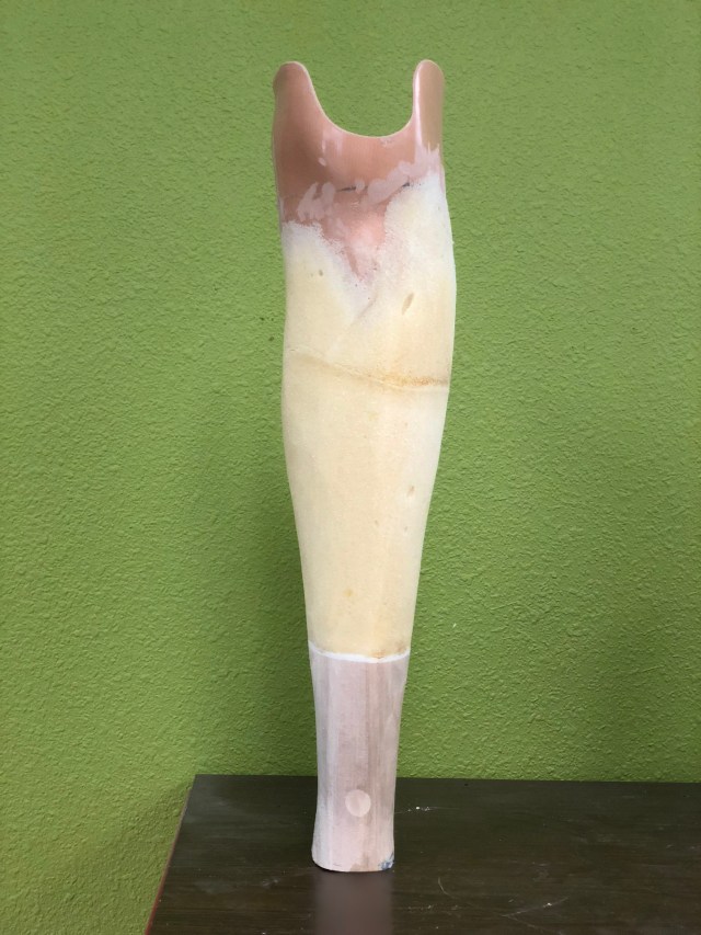 Prosthetics – Alex Miller O&P Portfolio